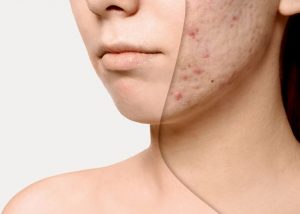 Laser Face Lift & Scar Removal