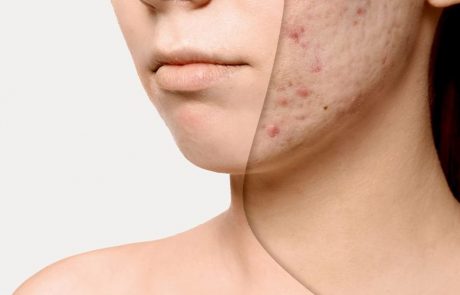 Laser Face Lift & Scar Removal