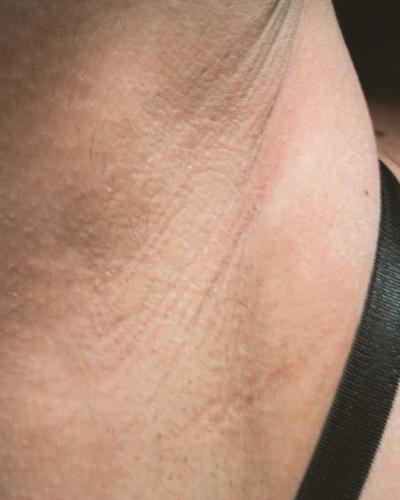 after laser hair reoval
