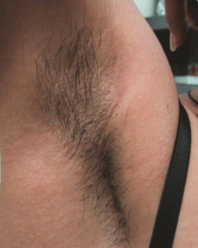 before laser hair removal