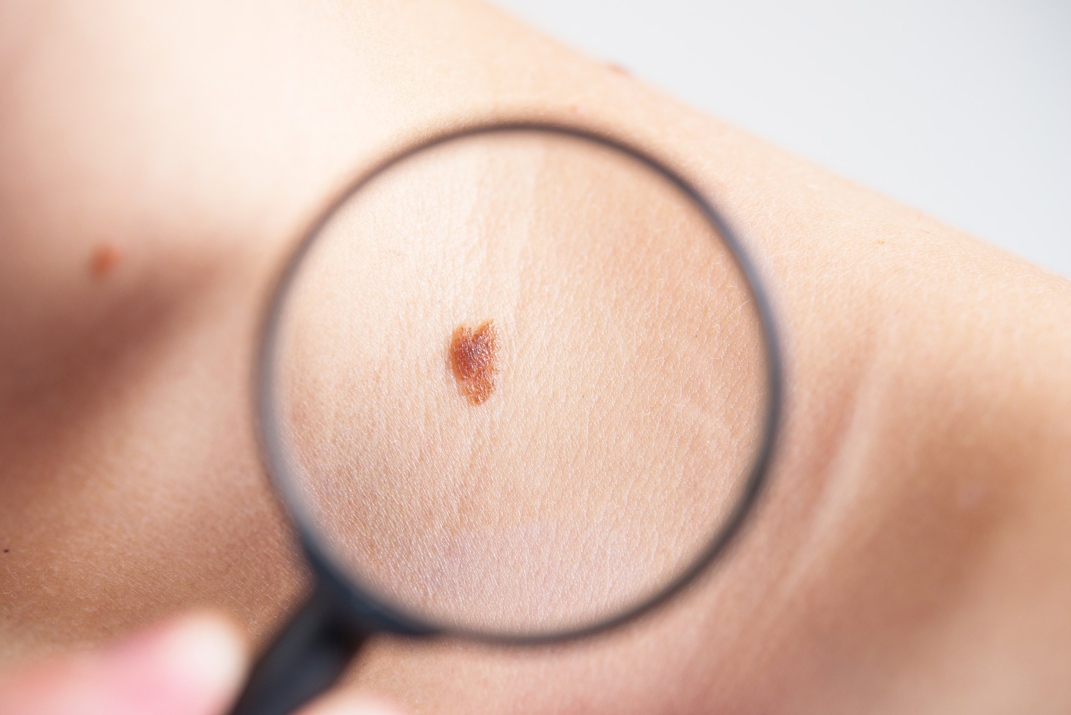 Can Age Spots Become Cancerous Cosmetic And Advance Laser Clinic