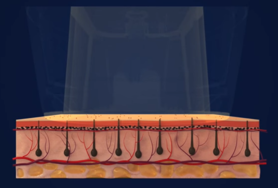 lhr-step1 laser hair removal toronto