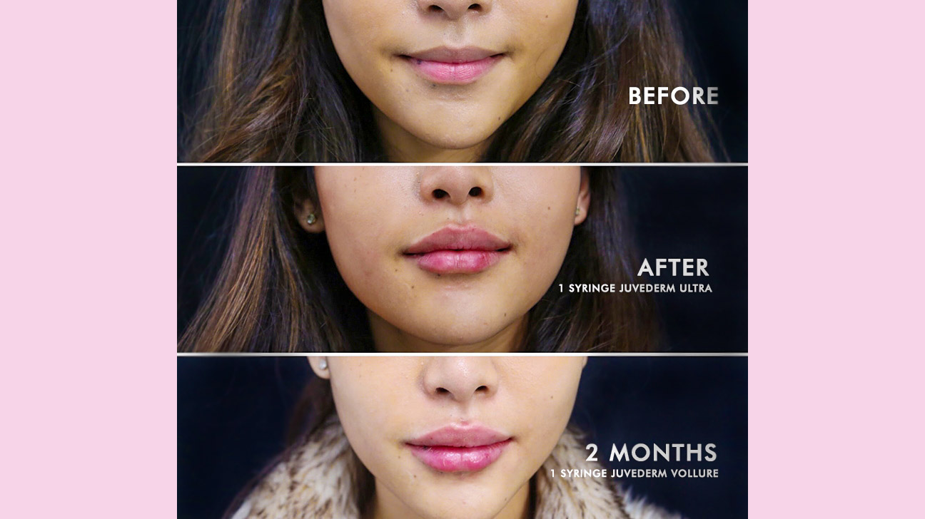 Things about getting lip fillers