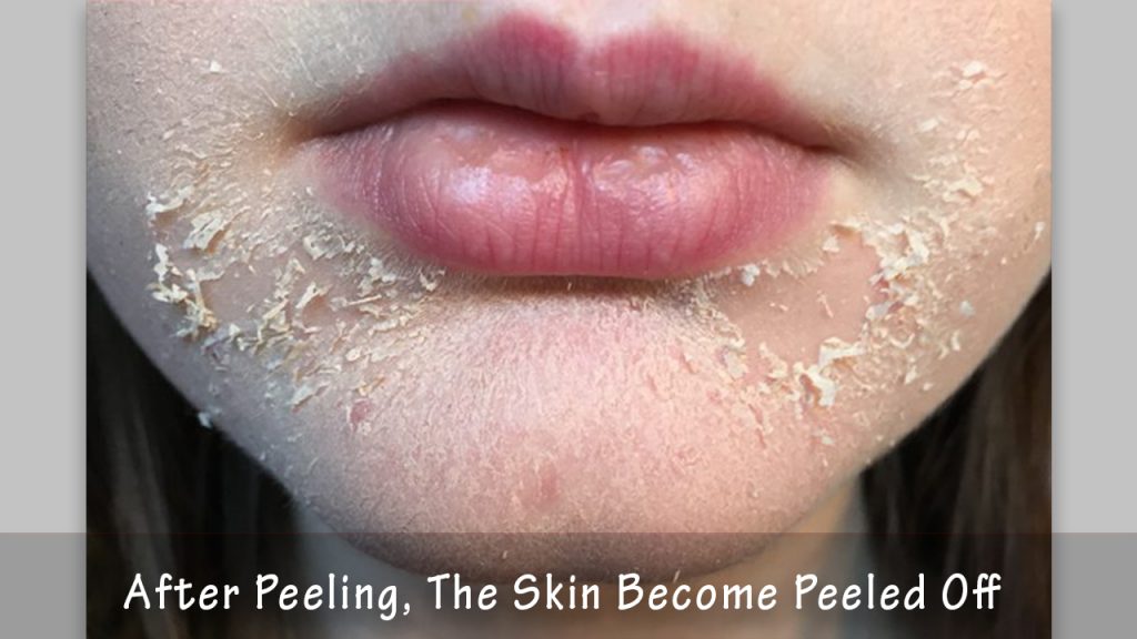 peeling-after-micro-needling-archives-richmond-hill-cosmetic-clinic