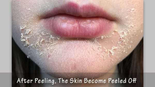 Peeling After Micro Needling Archives Richmond Hill Cosmetic Clinic 5627