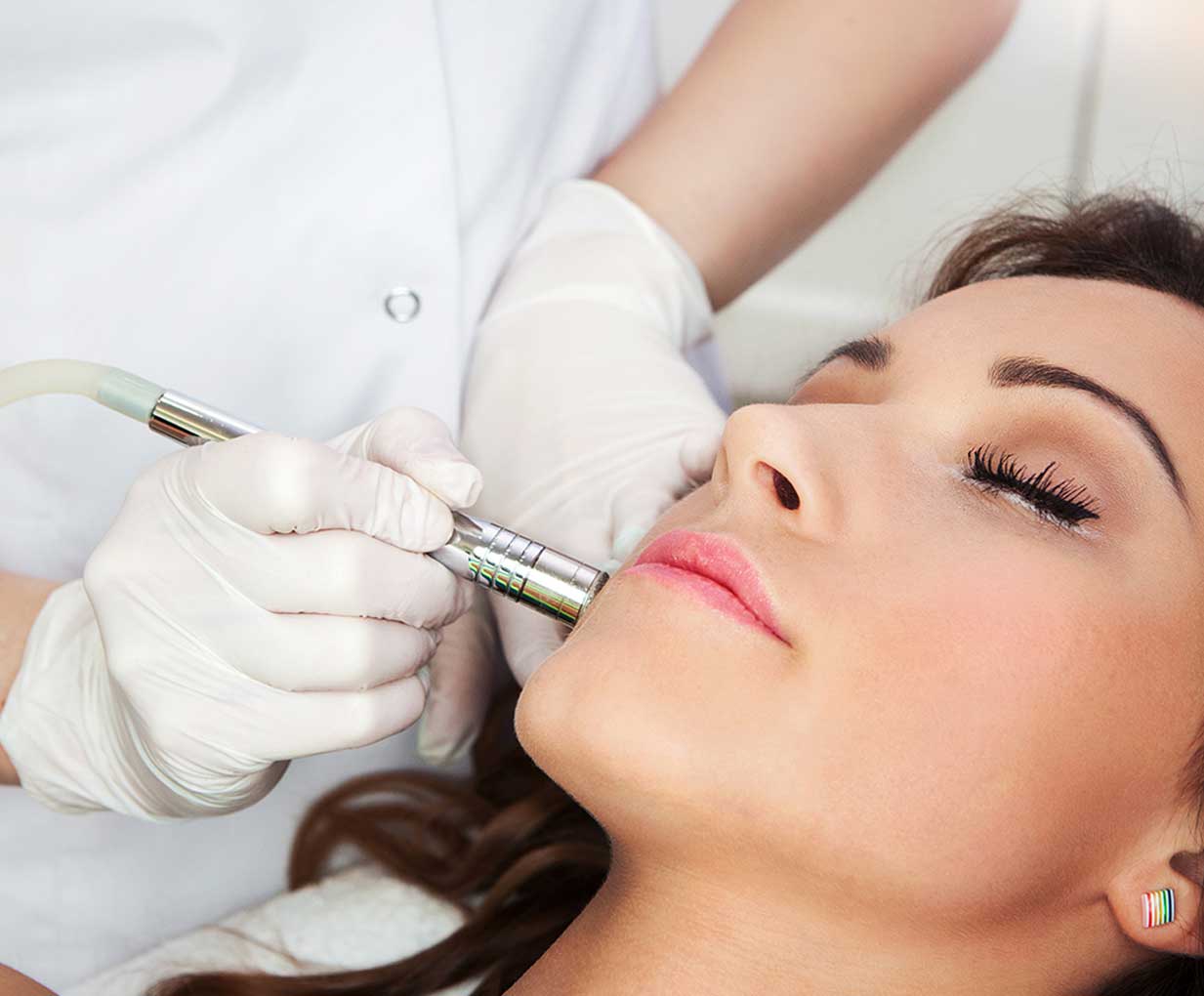 Microdermabrasion