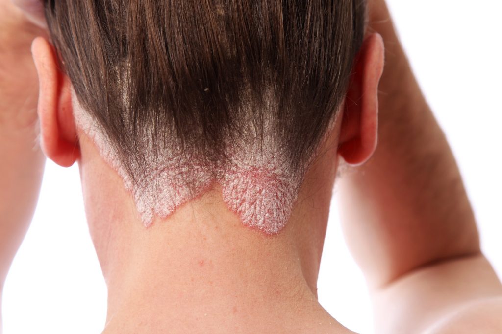 Does Burnt Hair Grow Back - Richmond Hill Cosmetic Clinic