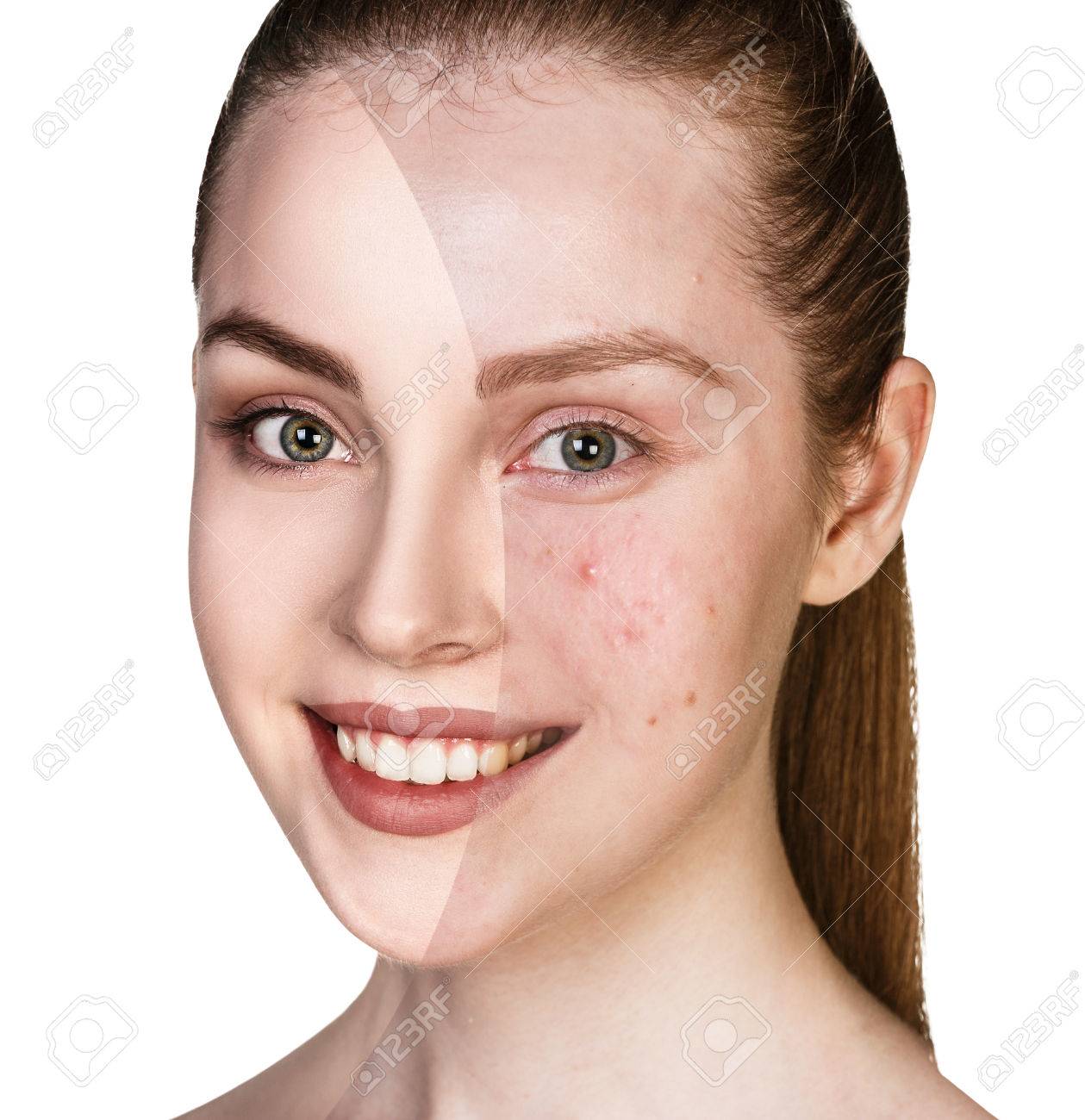 Acne Treatments That Really Work, According to Dermatologists
