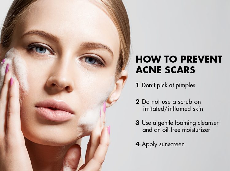 microdermabrasion-for-acne