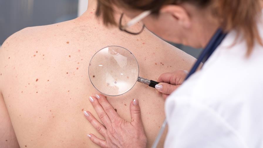 skin cancer