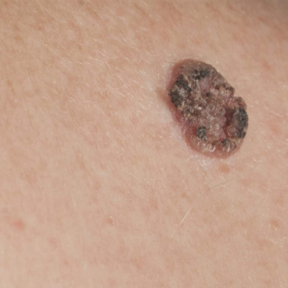 Squamous cell carcinoma (SCC)