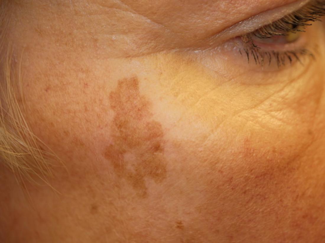 What Removes Age Spots On The Face - Printable Templates Protal