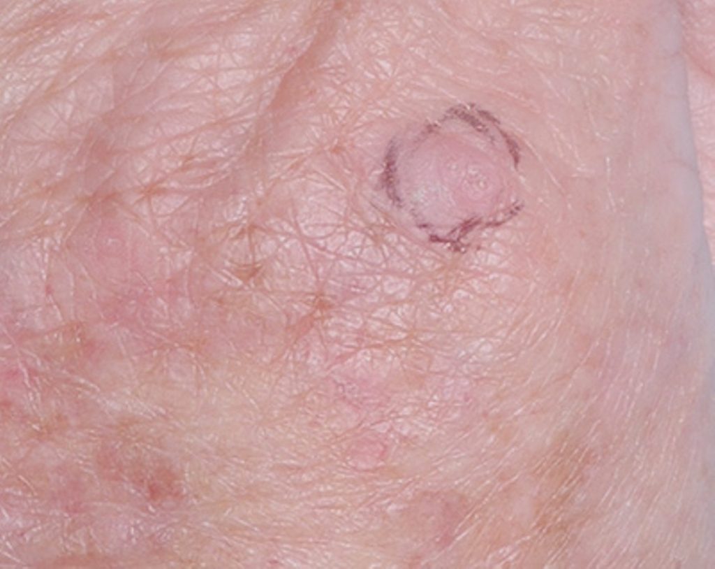 Types of skin cancer - Richmond Hill Cosmetic Clinic