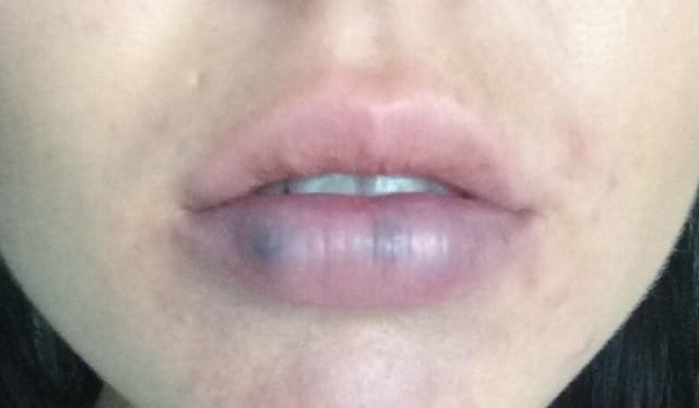 Tiny Black Dot On Lip DIY CRAFT   Hormonal Lip Problem 