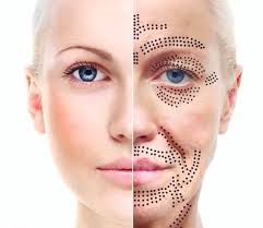 IPL uses a broad wavelength light that is a non-invasive treatment, pulsed onto the skin. It can treat multiple conditions simultaneously; including