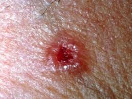 Basal cell carcinoma (BCC)