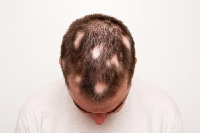 Alopecia areata : Causes, symptoms, and treatment - Richmond Hill Cosmetic  Clinic