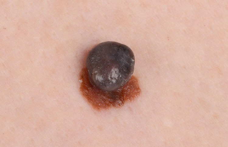 Melanoma