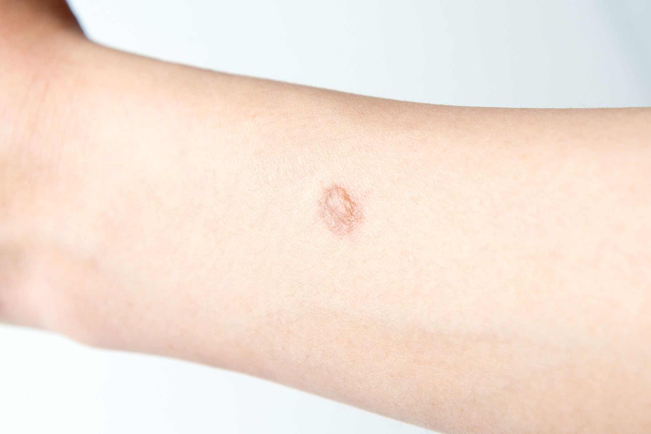 Everything About Keloid Scars Everything About Keloid Scars