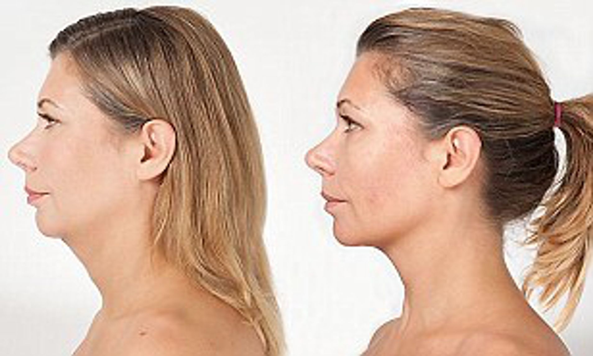 Can You Treat Turkey Neck Richmond Hill Cosmetic Clinic 3916