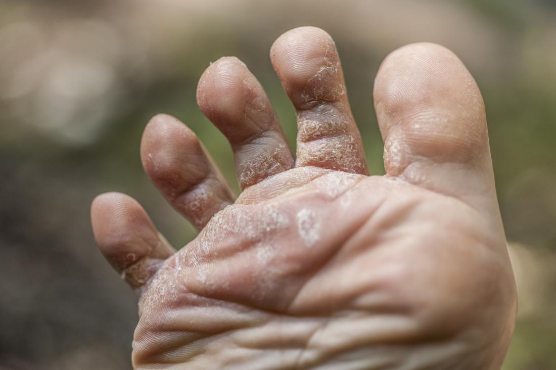 paronychia-causes-and-treatment-of-an-infected-nail