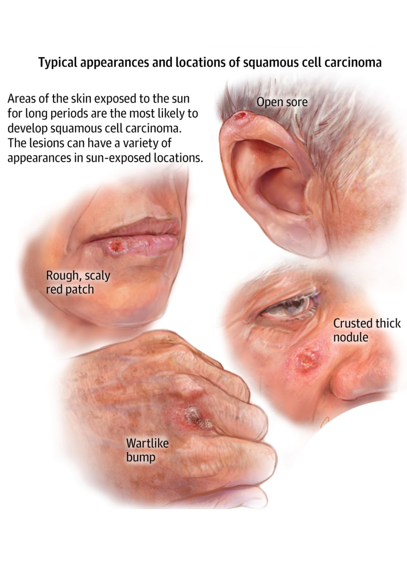 Does Carcinoma Always Mean Cancer