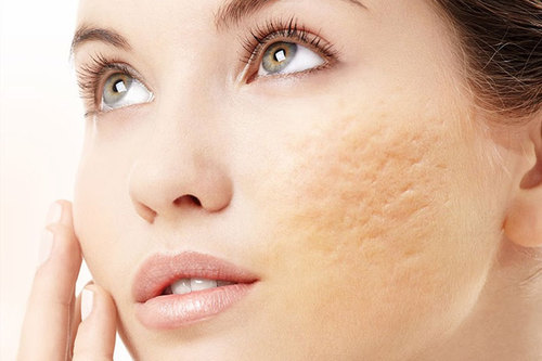 Fade Or Remove Chickenpox Scars Richmond Hill Cosmetic Clinic   Acne Scars Or Chicken Pox Scars 500x500 1 