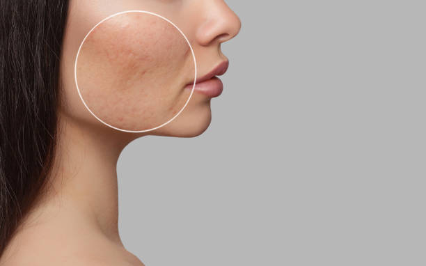 does-laser-pigmentation-removal-work-richmond-hill-cosmetic-clinic