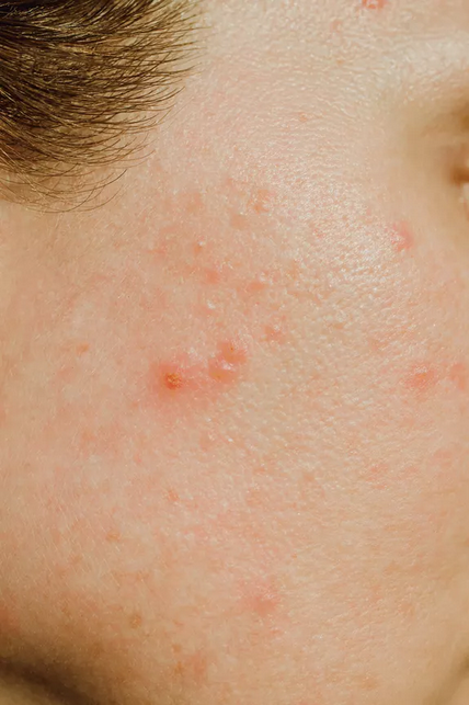 What Causes Acne Scars Richmond Hill Cosmetic Clinic 